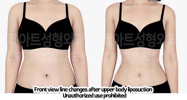 arm_liposuction_02_08_240219