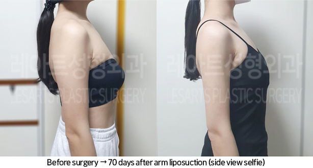 arm_liposuction_02_08_240709