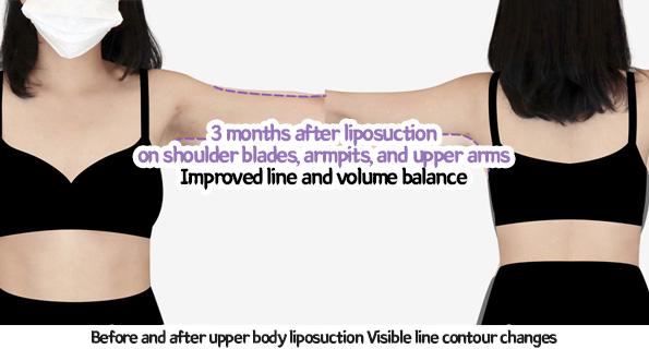 arm_liposuction_02_09_231226