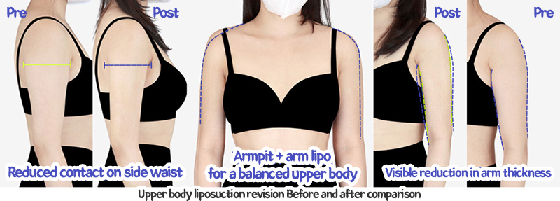 arm_liposuction_02_09_240105