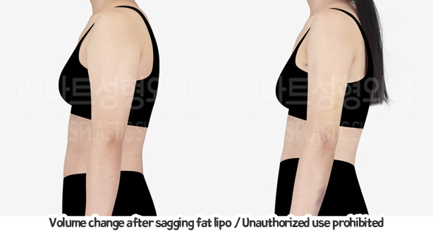 arm_liposuction_02_09_240129