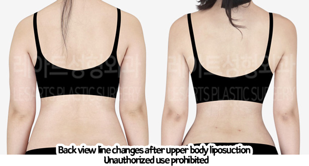 arm_liposuction_02_09_240219