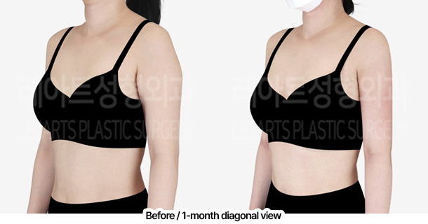 arm_liposuction_02_09_240229