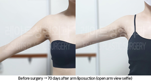 arm_liposuction_02_09_240709