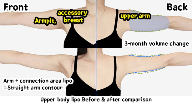arm_liposuction_02_10_240111