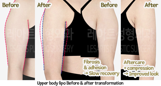 arm_liposuction_02_10_240117