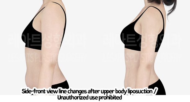 arm_liposuction_02_10_240219