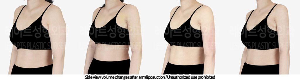 arm_liposuction_02_10_240219_2