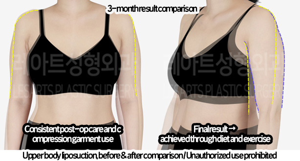 arm_liposuction_02_11_240219_2
