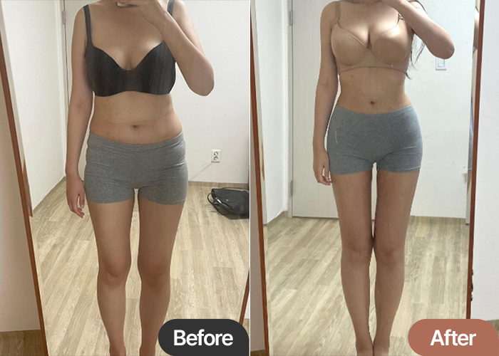 full-body-liposuction-TtubTtubiTtub
