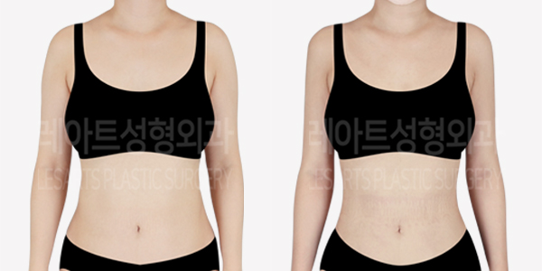 full_body_liposuction_01_thumbnail_240627