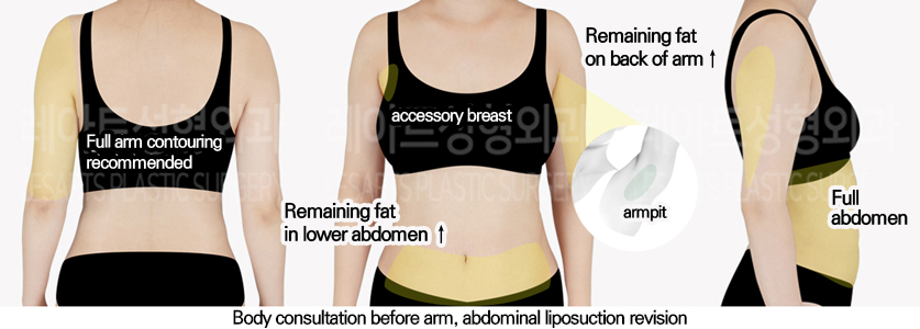 full_body_liposuction_02_01_240627