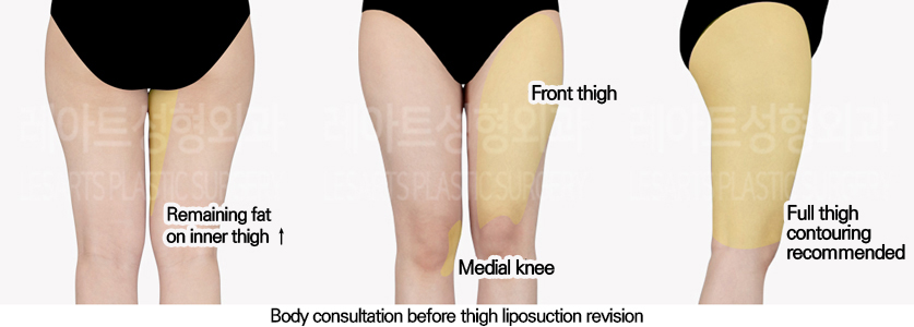 full_body_liposuction_02_02_240627