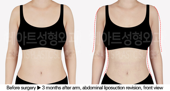 full_body_liposuction_02_03_240627