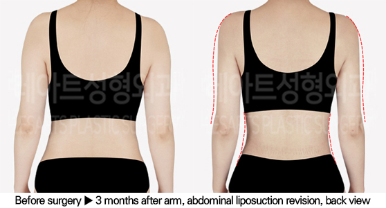 full_body_liposuction_02_04_240627