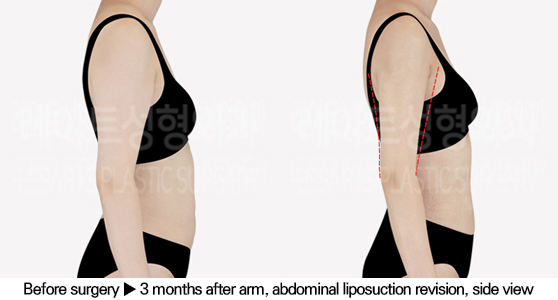 full_body_liposuction_02_05_240627
