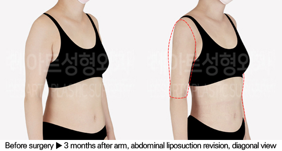 full_body_liposuction_02_06_240627