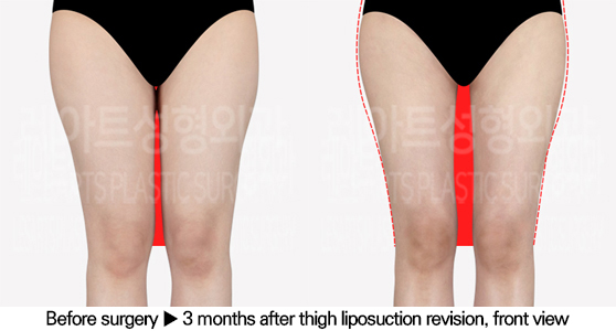 full_body_liposuction_02_07_240627