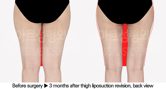 full_body_liposuction_02_08_240627