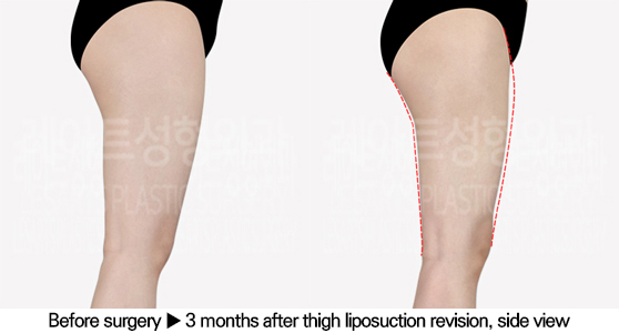 full_body_liposuction_02_09_240627