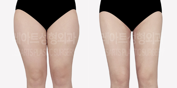 lower_body_liposuction_01_thumbnail_240718