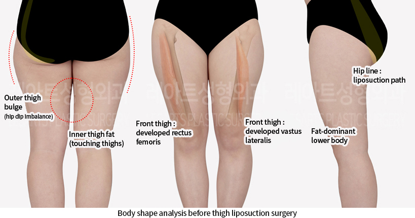 lower_body_liposuction_02_01_240718