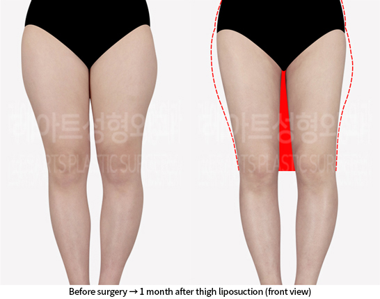lower_body_liposuction_02_02_240718