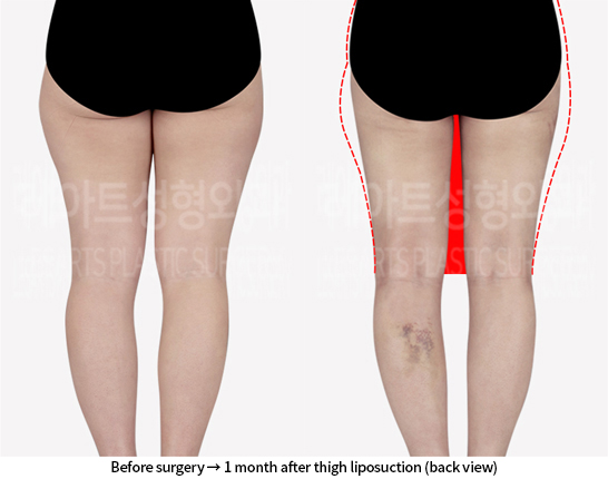 lower_body_liposuction_02_03_240718