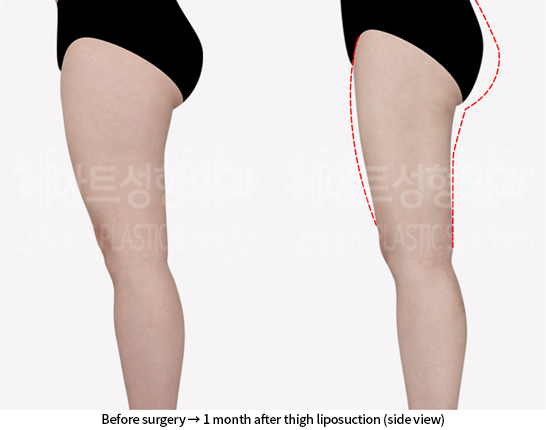 lower_body_liposuction_02_04_240718