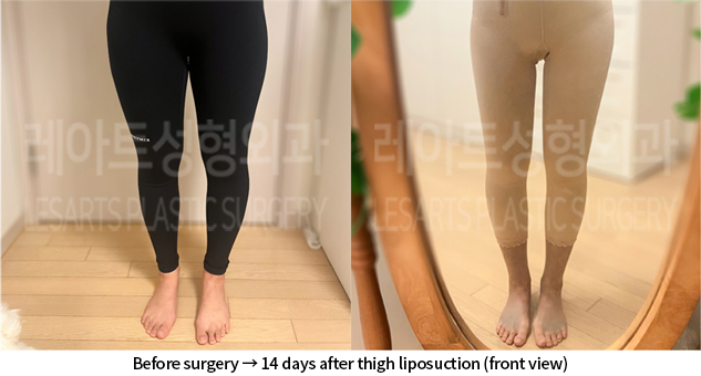 lower_body_liposuction_02_05_240718