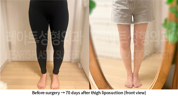 lower_body_liposuction_02_06_240718