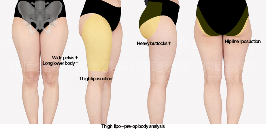 thigh-liposuction-02_01_240430