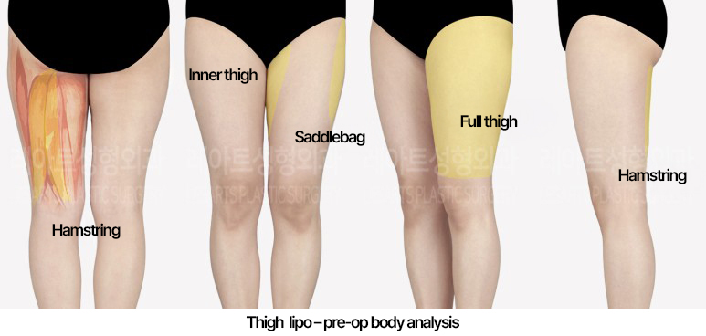 thigh-liposuction-02_01_240502