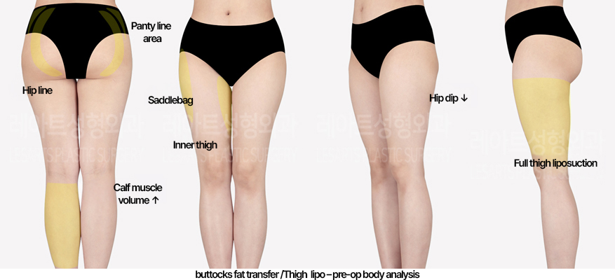 thigh-liposuction-02_01_240503