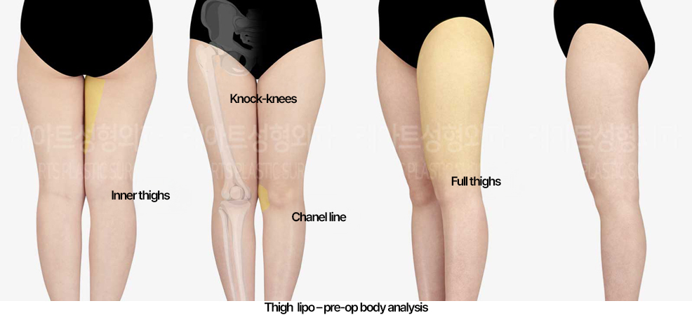 thigh-liposuction-02_01_240522