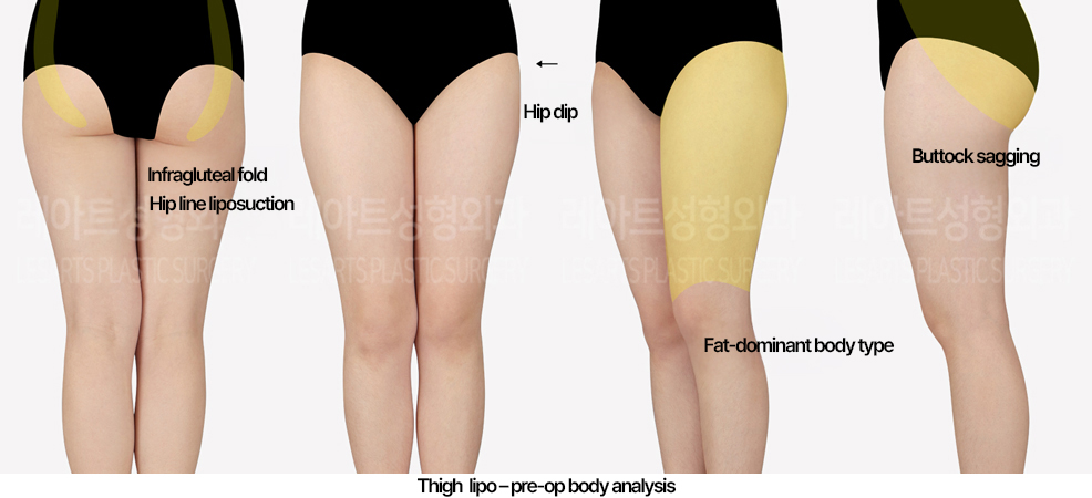 thigh-liposuction-02_01_240523