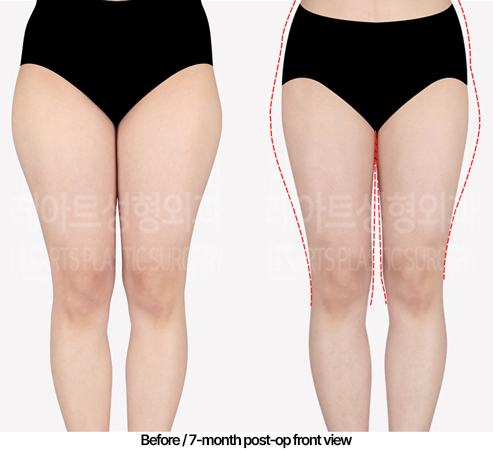 thigh-liposuction-02_02_240430