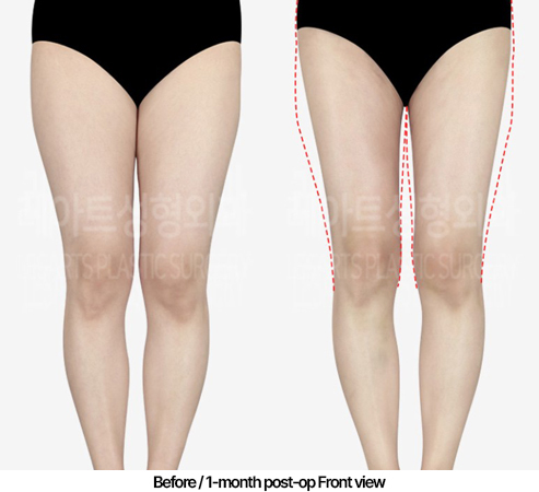 thigh-liposuction-02_02_240502