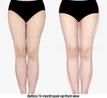 thigh-liposuction-02_02_240503