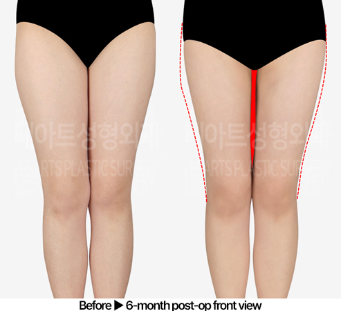 thigh-liposuction-02_02_240523