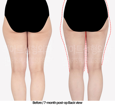 thigh-liposuction-02_03_240430