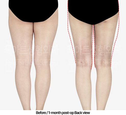 thigh-liposuction-02_03_240502