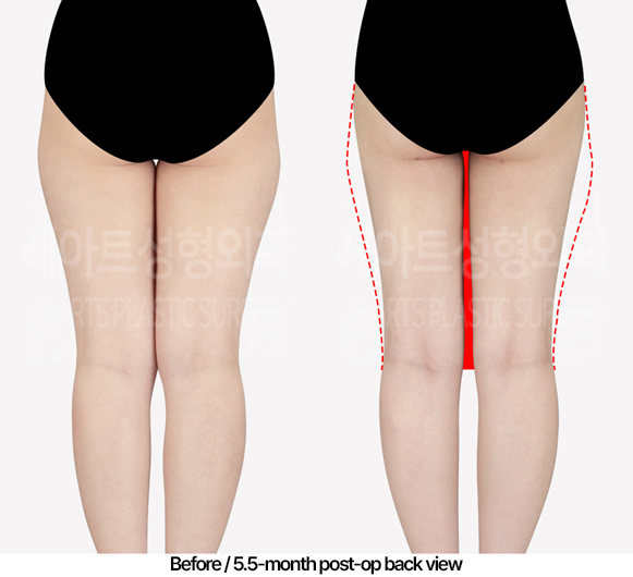 thigh-liposuction-02_03_240522