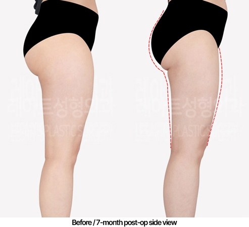 thigh-liposuction-02_04_240430