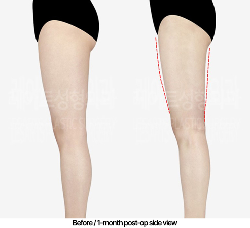 thigh-liposuction-02_04_240502