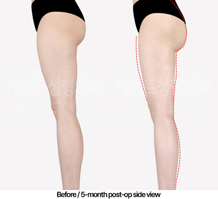 thigh-liposuction-02_04_240503