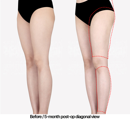 thigh-liposuction-02_05_240503