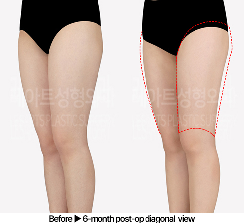thigh-liposuction-02_05_240523