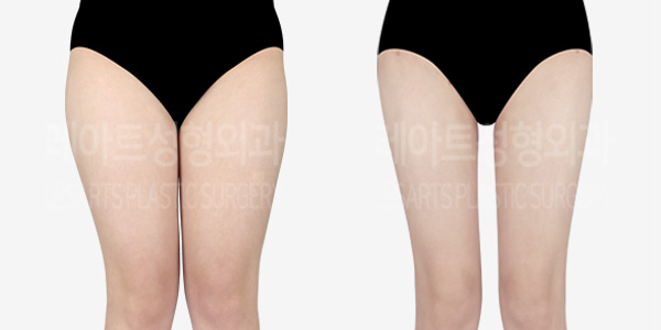 thigh-liposuction-Hip-Dip-Fat transfer-01_thumbnail_230422