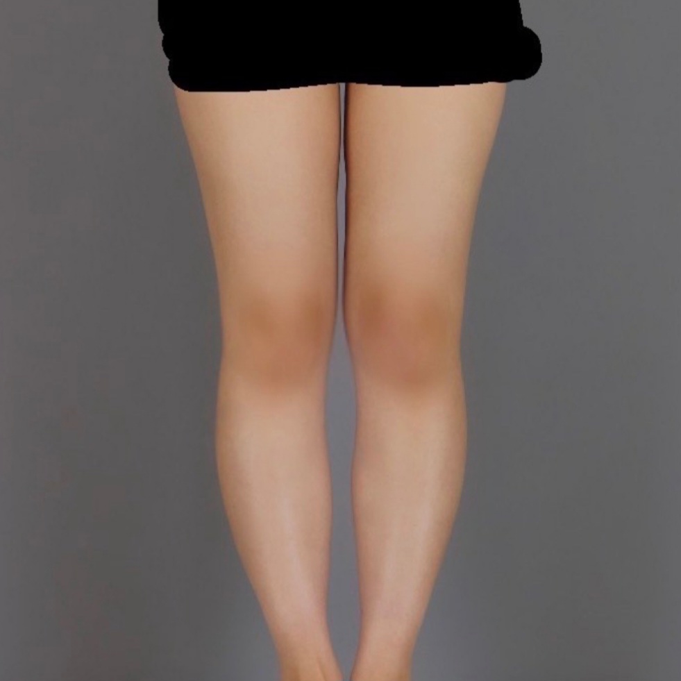 thigh-liposuction-before-selfie